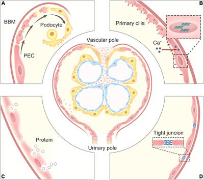 The Role of Parietal Epithelial Cells in the Pathogenesis of Podocytopathy